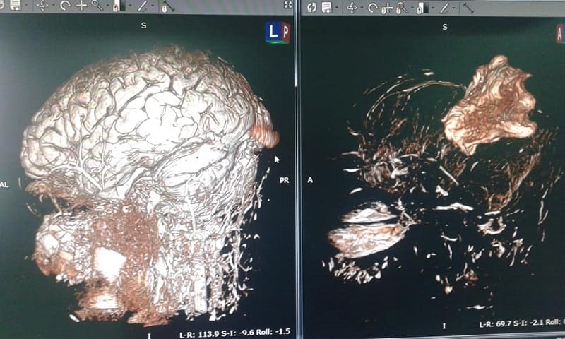 1era operación de mapeo cerebral del lenguaje con paciente despierto